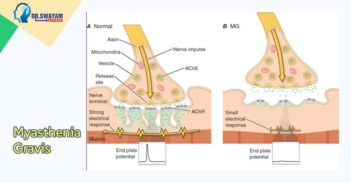 Myasthenia Gravis